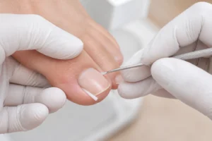Podolog zakłada tamponadę przy bocznym brzegu paznokcia stopy — zdjęcie poglądowe